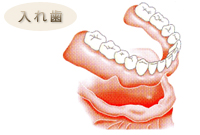 入れ歯 全ての歯を失った場合