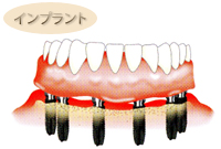 インプラント 全ての歯を失った場合