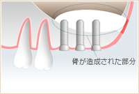 ソケットリフト(上顎洞粘膜挙上法)