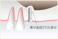 フラップレス手術