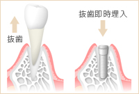 抜歯即時埋入手術